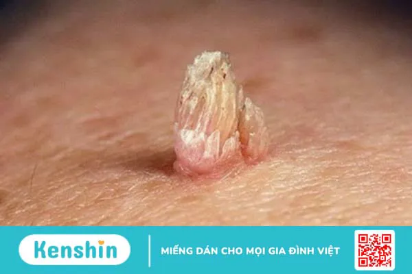 bi-sui-mao-ga-co-tiem-phong-hpv-duoc-khong 2