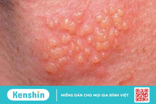 bi-sui-mao-ga-co-tiem-phong-hpv-duoc-khong 4