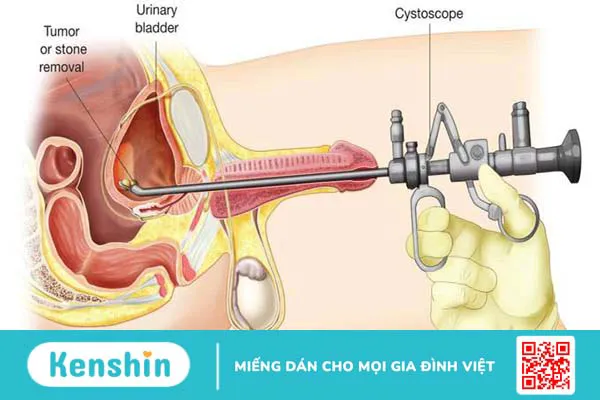 Bật mí ngay viêm bàng quang có uống nước dừa được không! 4