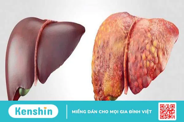 Bị viêm gan B nên uống nước gì? 5 đồ uống tốt cho người viêm gan B