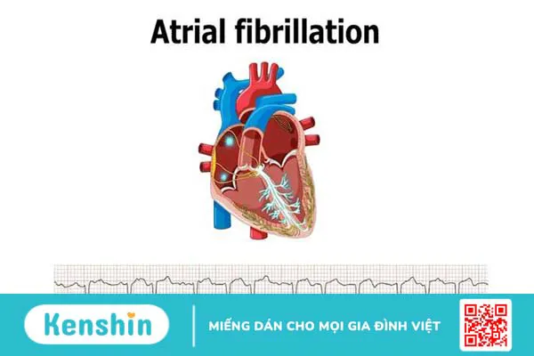 Bít tiểu nhĩ - Giải pháp ngăn ngừa đột quỵ ở bệnh nhân rung nhĩ 1