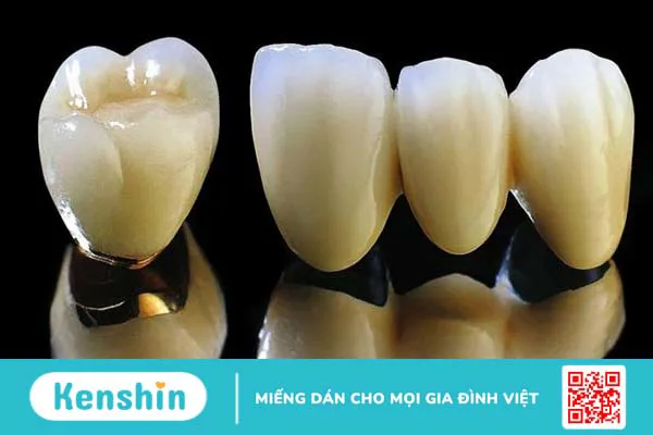 Bọc răng sứ 4 răng cửa giá bao nhiêu? Nên bọc loại nào tốt? 5