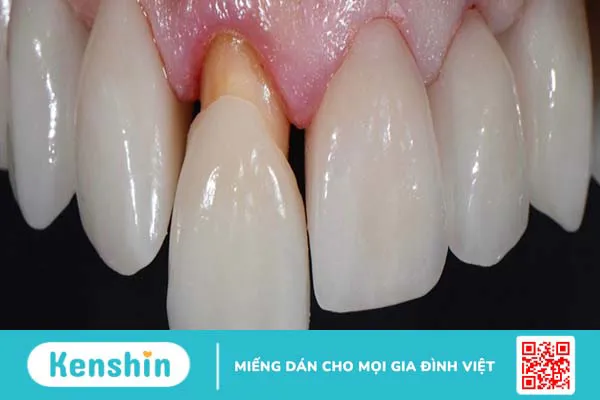 Bọc răng sứ lần 2 thực hiện như thế nào và cần lưu ý những gì? 1