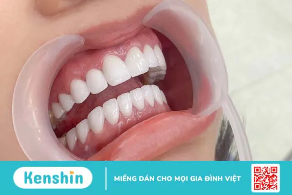 Bọc răng sứ lần 2 thực hiện như thế nào và cần lưu ý những gì? 2