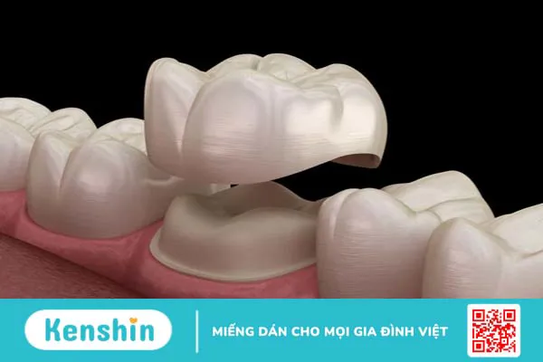 Bọc răng sứ nguyên hàm giá bao nhiêu tiền? So sánh ưu nhược điểm từng loại 1