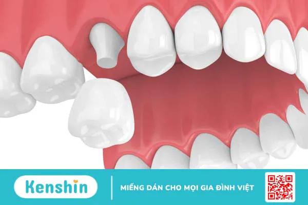 Bọc sứ 16 răng là gì? Chất liệu nào thường được sử dụng để bọc sứ? 1