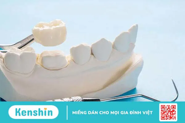 Bọc sứ 16 răng là gì? Chất liệu nào thường được sử dụng để bọc sứ? 3