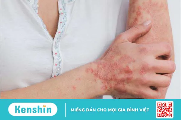 Các bệnh da liễu thường gặp ở nam giới và cách giải quyết 2