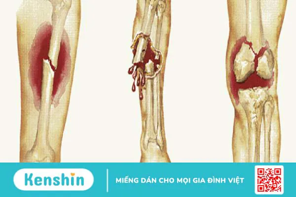 Các dấu hiệu gãy xương là như thế nào? 1