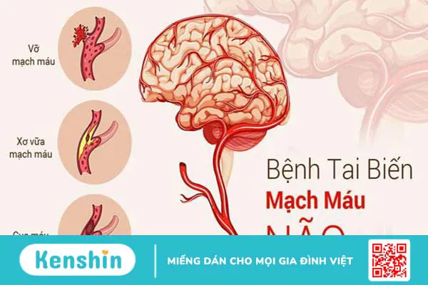 Các di chứng tai biến mạch máu não thường gặp là gì? 1