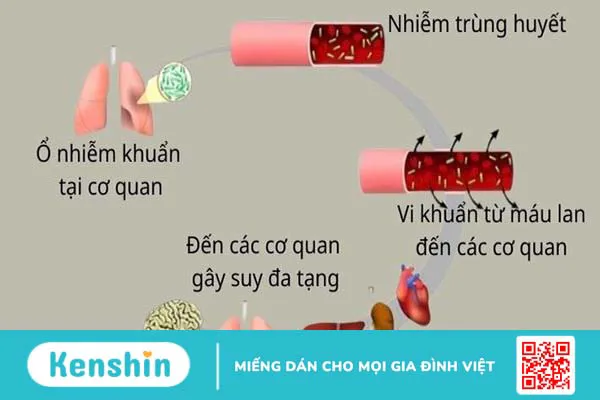 Các giai đoạn của nhiễm khuẩn huyết: Nguy cơ, dấu hiệu và phương pháp điều trị 3