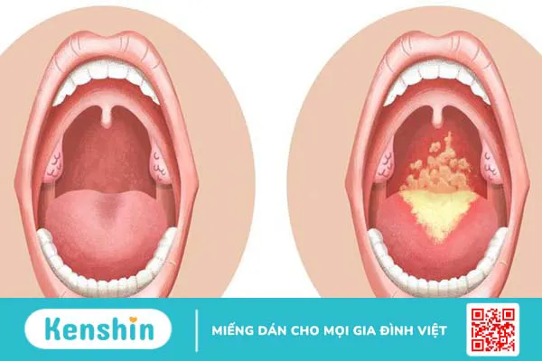 Các loại nấm gây bệnh trên người -4