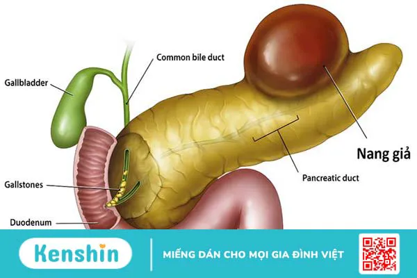 Các phương pháp điều trị nang giả tụy phổ biến hiện nay