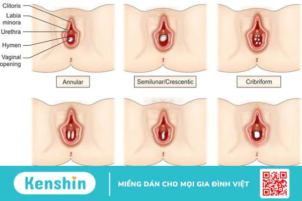 Các phương pháp vá màng trinh và quy trình thực hiện 1