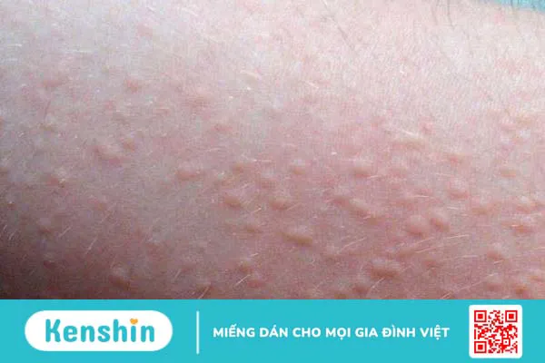 Các tác dụng phụ của thuốc Depakine cần lưu ý 2