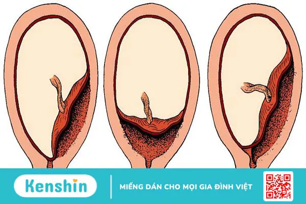 Cách cầm máu khi bị nhau tiền đạo hiệu quả 1