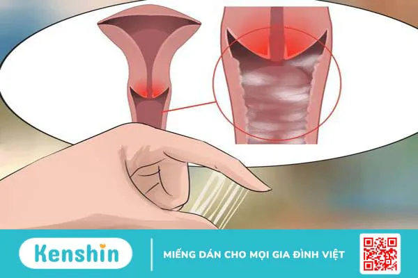 Cách chữa bệnh viêm nhiễm phụ khoa. Làm sao để phòng ngừa? 1