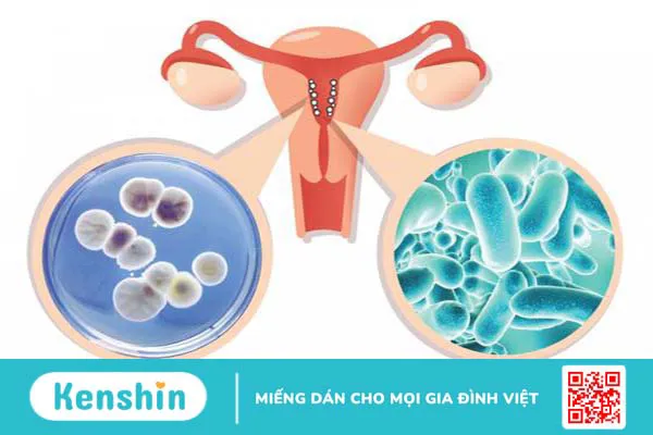 Cách chữa bệnh viêm nhiễm phụ khoa. Làm sao để phòng ngừa? 3