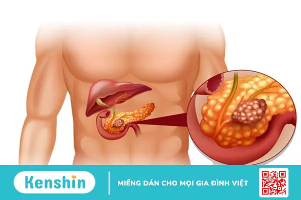 Cách điều trị ung thư tuyến tụy thường được dùng nhất hiện nay -2