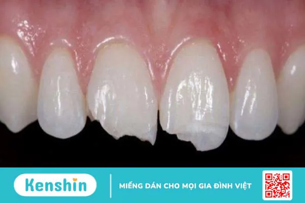 Cách khắc phục tình trạng bị hô 4 răng cửa 3