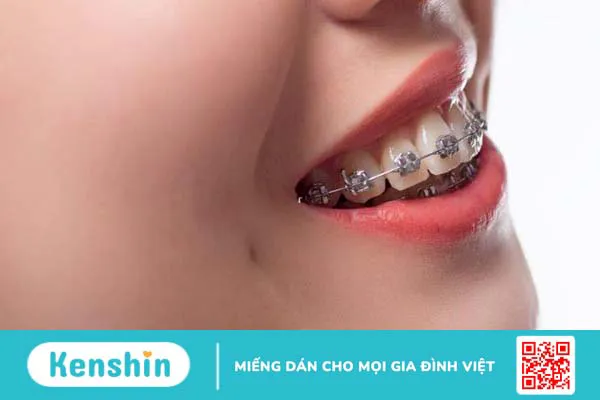 Cách khắc phục tình trạng bị hô 4 răng cửa 4