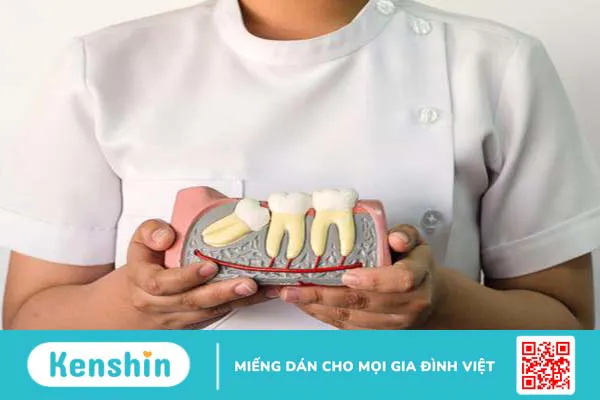 Cách làm giảm sưng nướu răng khôn, hạn chế đau nhức 1