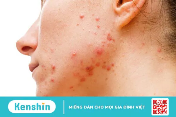 Cách nặn mụn bọc an toàn và không gây sẹo 1