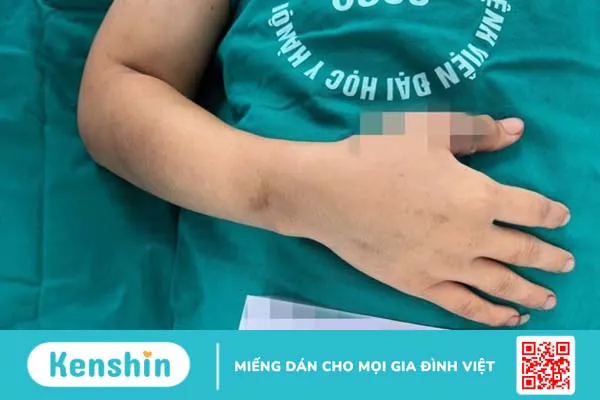 Cách sơ cứu và bảo quản chi thể đứt rời 1