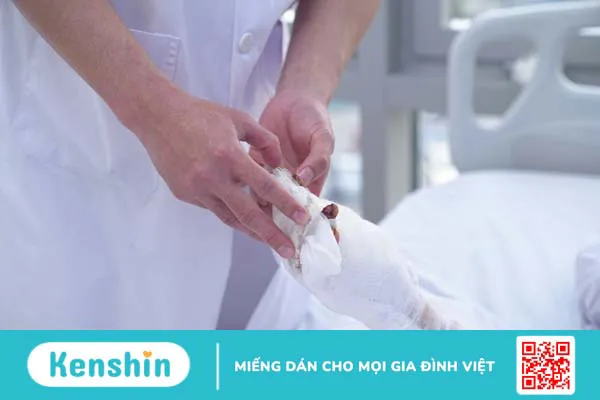 Cách sơ cứu và bảo quản chi thể đứt rời 3