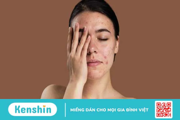 Cách sử dụng bột diếp cá đắp mặt trị mụn, làm sáng da, chống lão hoá 1