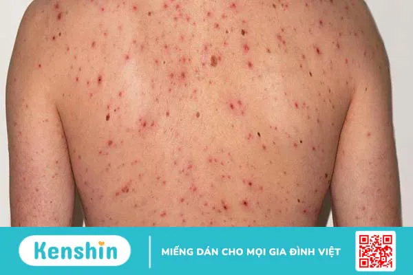 Cách trị mụn lưng cho nam hiệu quả bất ngờ 1