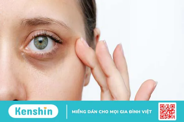 Cách trị thâm mắt đơn giản tại nhà, giúp mắt thêm sáng đẹp, tươi tắn 1