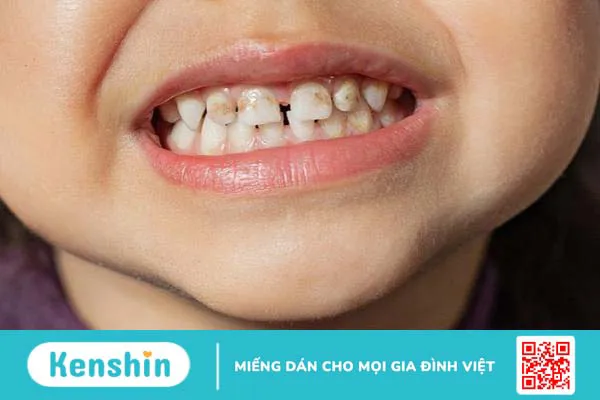 Cách xử lý khi răng sữa của trẻ bị mòn như thế nào là đúng? 1