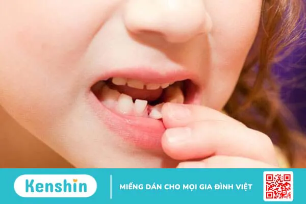 Cách xử lý khi răng sữa của trẻ bị mòn như thế nào là đúng? 2