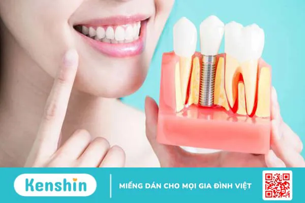 Cắm implant có niềng răng được không? Cần lưu ý gì? 1