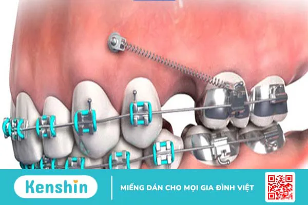 Cắm vis là gì? Khi nào cần phải cắm vis 1