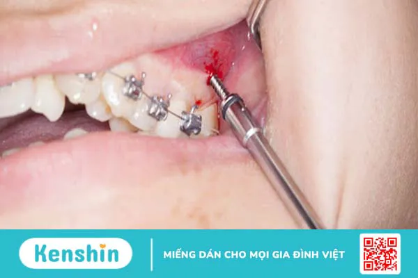 Cắm vis là gì? Khi nào cần phải cắm vis 2