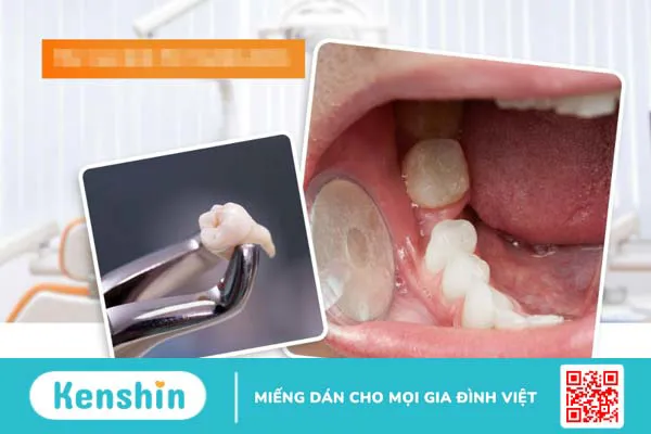 Cắm vis là gì? Khi nào cần phải cắm vis 3