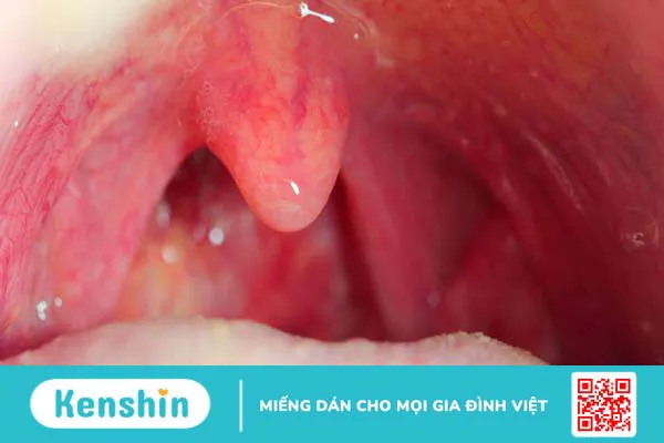 Cần kiêng gì sau khi cắt amidan để cơ thể nhanh hồi phục?