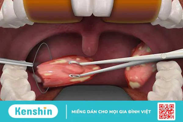 Cần kiêng gì sau khi cắt amidan để cơ thể nhanh hồi phục? 1