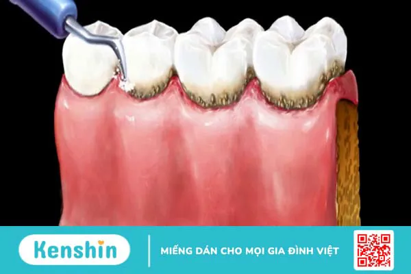 Cao răng hình thành thế nào và lấy cao răng có ảnh hưởng gì đến răng không? 1