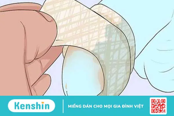 Cắt bao quy đầu có tác dụng gì? Những lợi ích không ngờ của phẫu thuật cắt bao quy đầu 4