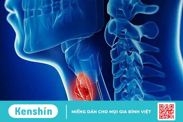 Cắt thanh quản toàn phần trong điều trị ung thư thanh quản 1