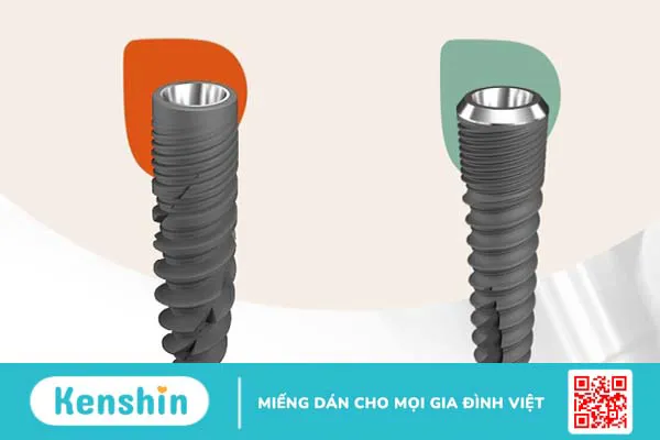 Cấy ghép trụ implant etk có thực sự an toàn? 1