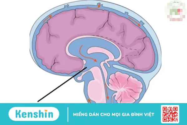 Chẩn đoán và điều trị chứng: Đau đầu sau thủng màng cứng 1