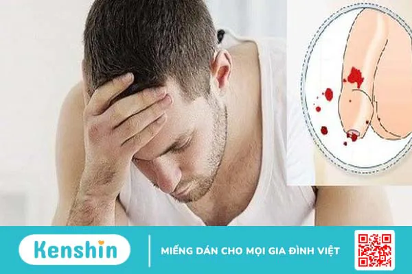 Chảy máu dương vật ở nam giới có sao không? Nguyên nhân và cách xử lý 1