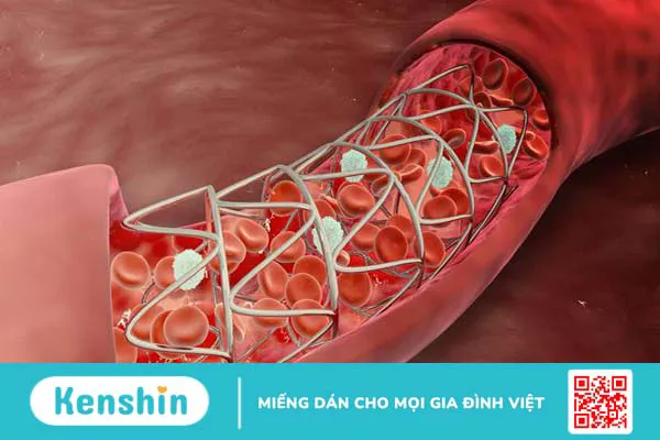 goc-giai-dap-chi-phi-dat-stent-tim-la-bao-nhieu 1