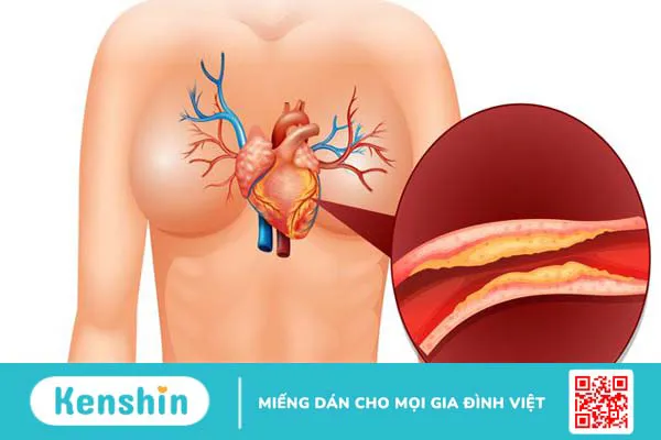 goc-giai-dap-chi-phi-dat-stent-tim-la-bao-nhieu 2