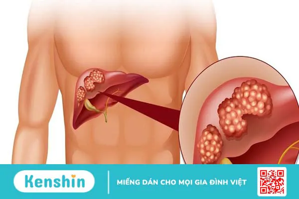 Chỉ số xét nghiệm SGOT là gì? Khi nào cần xét nghiệm SGOT? 1