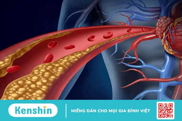 Cholesterol là gì? Kiểm soát cholesterol trong máu thế nào? 1